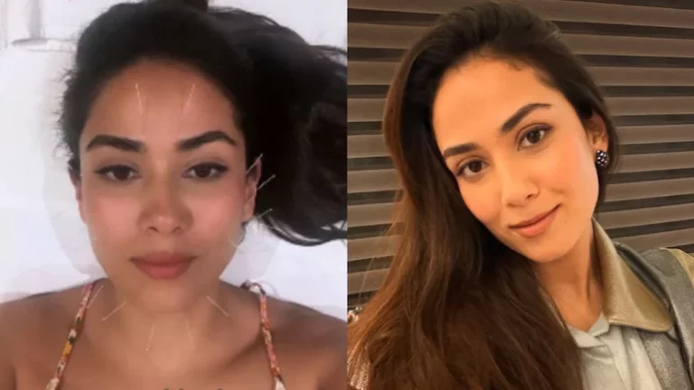 Mira Kapoor Claims Facial Acupuncture Tightens Skin, What A Delhi Dermatologist Says